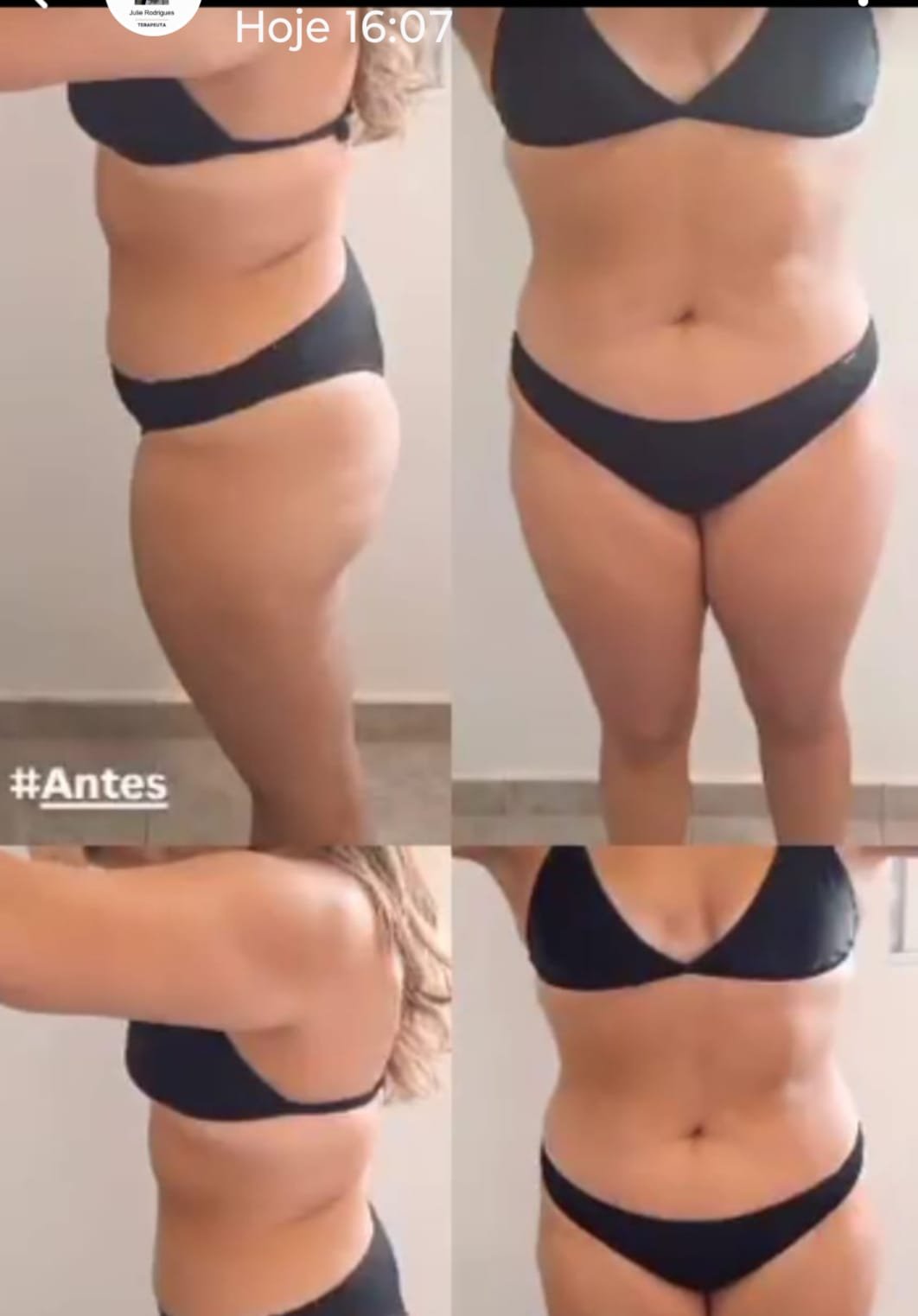 Drenagem linfática